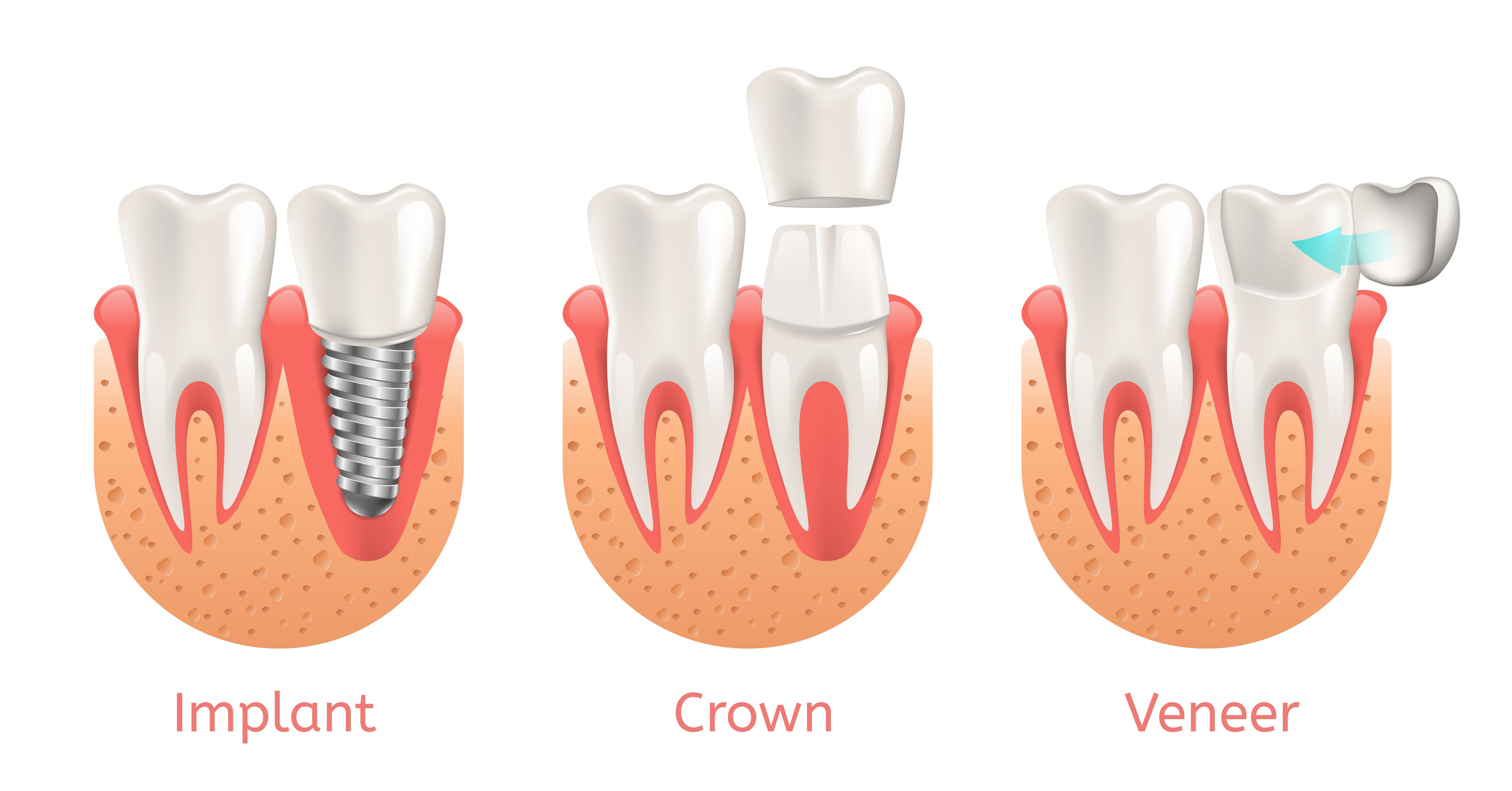 Three examples of what a dental implant, dental crown, and a veneer look like.